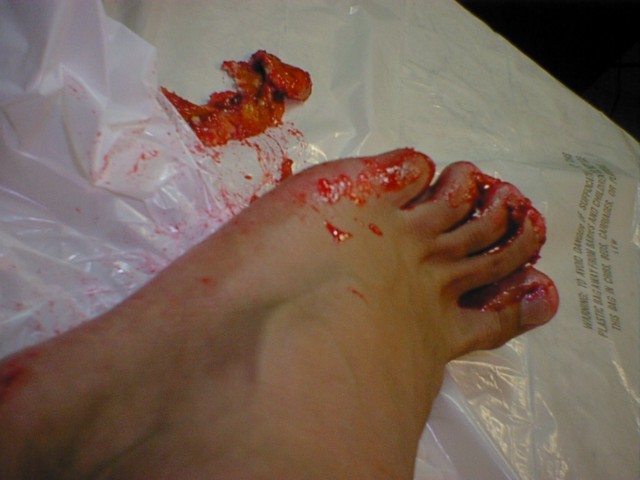 Franks foot covered with jelly